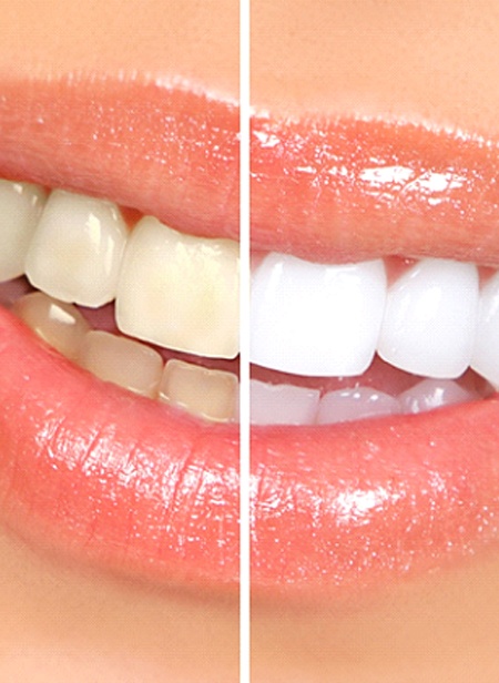 Closeup of teeth whitening in Manchester before and after