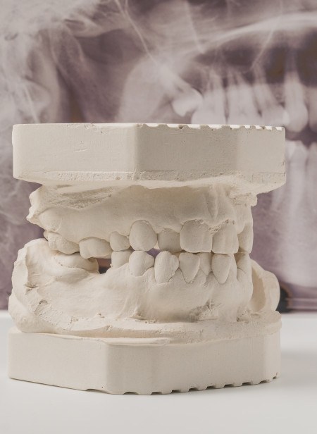 Example of dentures being made in Manchester